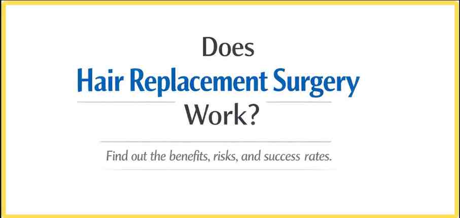 Does Hair Replacement Surger