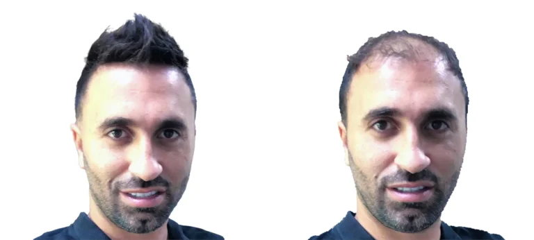 خدماتنا في تركيب وتثبيت الشعر