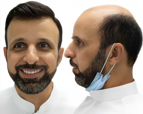 مركز بروفيشنال لتركيب الشعر